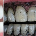 Can Yellow Teeth Turn White Again? A Comprehensive Guide