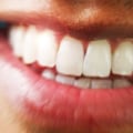 Do Teeth Whitening Products Really Work?