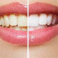 Can Stained Teeth Go Back to White?