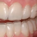 Does Teeth Whitening Damage Enamel? An Expert's Perspective