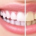 How to Reverse Yellow Teeth and Achieve a Brighter Smile