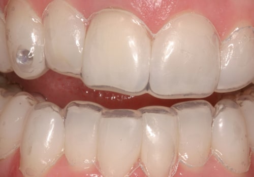 Does Teeth Whitening Damage Enamel? An Expert's Perspective