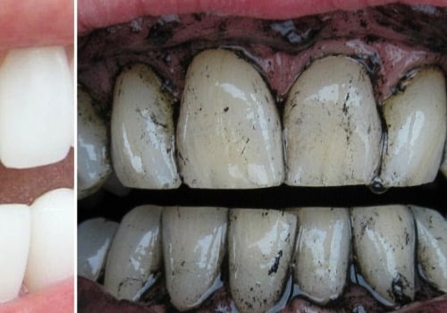 Can Yellow Teeth Turn White Again? A Comprehensive Guide