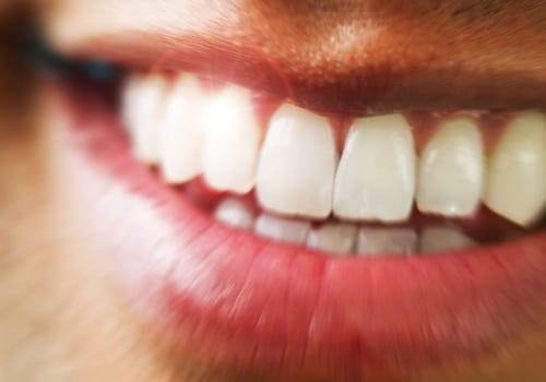 Do Teeth Whitening Products Really Work?