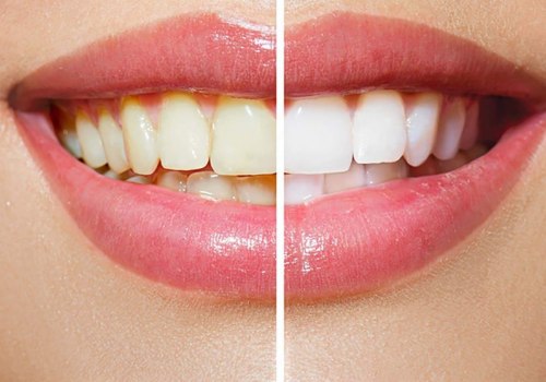 How to Whiten Yellow Teeth and Restore Your Bright Smile