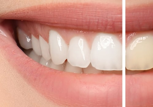 The Benefits of Professional Teeth Whitening