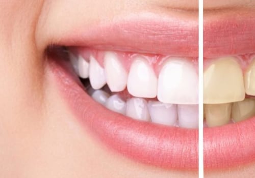 How to Reverse Yellow Teeth and Achieve a Brighter Smile